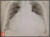 Image of the Week: Cardiomegaly Image of the Week: Cardiomegaly