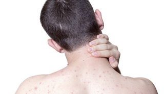 Insulin resistance not linked to post-adolescent acne Insulin resistance not linked to post-adolescent acne