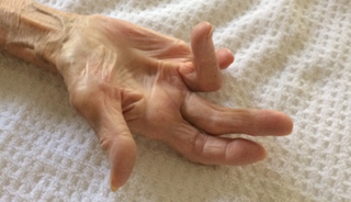 Dupuytren disease: A hands-on condition Dupuytren disease: A hands-on condition