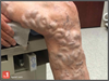 Image of the Week: Treating severe varicose veins Image of the Week: Treating severe varicose veins
