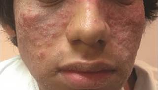July 2015 Dermatology CME/CE July 2015 Dermatology CME/CE