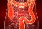 High rates of colorectal cancer in select parts of U.S. High rates of colorectal cancer in select parts of U.S.