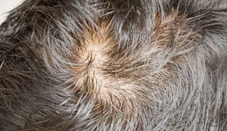 Lower serum zinc levels predict worse outcomes in alopecia areata. Lower serum zinc levels predict worse outcomes in alopecia areata.