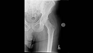 Fractures of the hip may be seen more in patients with subclinical hyperthyroidism. Fractures of the hip may be seen more in patients with subclinical hyperthyroidism.