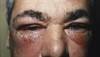 Itchy red rash and
periorbital swelling Itchy red rash and
periorbital swelling