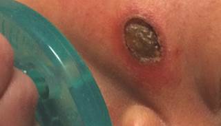 August 2015 Dermatology CME/CE August 2015 Dermatology CME/CE