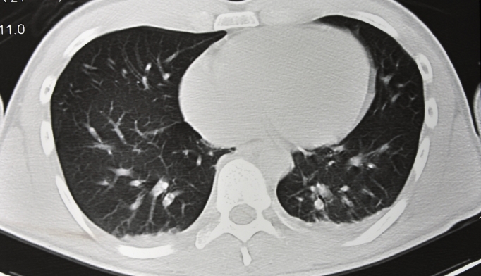 More incidental pulmonary nodules result from increased 