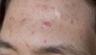 The combination treatment was effective for severe acne vulgaris. The combination treatment was effective for severe acne vulgaris.