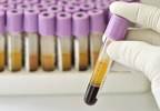 A New Biomarker for Disease Activity in Psoriatic Arthritis? A New Biomarker for Disease Activity in Psoriatic Arthritis?