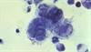 Can Herpes Cause Alzheimer's Disease? Can Herpes Cause Alzheimer's Disease?