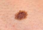 Laser technique accurately identifies melanoma Laser technique accurately identifies melanoma