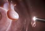 Colorectal cancer screening recommended for patients aged 50 to 75 years Colorectal cancer screening recommended for patients aged 50 to 75 years