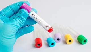Patients previously treated for HCC have a high risk of tumor recurrence in the long term. Patients previously treated for HCC have a high risk of tumor recurrence in the long term.