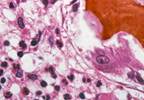 Painful red spot
and fever in an infant Painful red spot
and fever in an infant