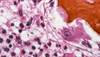 Painful red spot
and fever in an infant Painful red spot
and fever in an infant