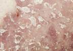 Biologic agents associated with high risk of hepatitis B virus flares in patients with psoriasis or rheumatoid arthritis Biologic agents associated with high risk of hepatitis B virus flares in patients with psoriasis or rheumatoid arthritis