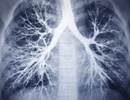 Increased Mortality Related to Interstitial Lung Abnormalities Increased Mortality Related to Interstitial Lung Abnormalities
