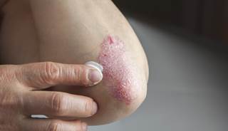 Dermatologic drug prices – including treatments for psoriasis – have risen, on average, 401% between 2009 and 2015. Dermatologic drug prices – including treatments for psoriasis – have risen, on average, 401% between 2009 and 2015.