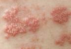 Shingles increases stroke, myocardial infarction risk in the elderly Shingles increases stroke, myocardial infarction risk in the elderly