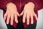 Patients with RA display lower disease activity at NP, PA-staffed practices Patients with RA display lower disease activity at NP, PA-staffed practices