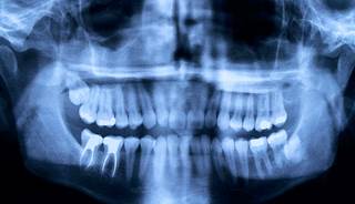 Postmenopausal women with periodontal disease have an elevated risk for breast cancer. Postmenopausal women with periodontal disease have an elevated risk for breast cancer.