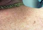 Enlarging brown spots:
a misdiagnosed solar lentigo? Enlarging brown spots:
a misdiagnosed solar lentigo?