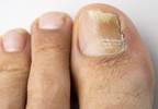 Laser therapy for onychomycosis of the toenails Laser therapy for onychomycosis of the toenails