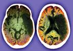 Initiating alpha-blocker therapy linked to higher risk of stroke in men Initiating alpha-blocker therapy linked to higher risk of stroke in men