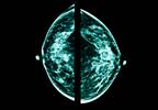 False-positive mammograms and breast cancer risk False-positive mammograms and breast cancer risk