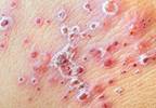 Shingles increases stroke, MI risk in elderly Shingles increases stroke, MI risk in elderly