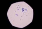 More life-threatening scope-related infections than previously thought More life-threatening scope-related infections than previously thought