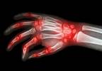 DMARDs remain first choice of therapy for rheumatoid arthritis DMARDs remain first choice of therapy for rheumatoid arthritis