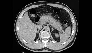 Pediatric pancreatitis contributes to high healthcare costs and recurrent hospitalizations. Pediatric pancreatitis contributes to high healthcare costs and recurrent hospitalizations.