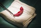 Carcinoid appendix Carcinoid appendix
