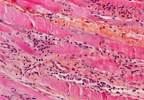 Markedly elevated serum transaminase levels Markedly elevated serum transaminase levels