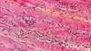 Markedly elevated serum transaminase levels Markedly elevated serum transaminase levels