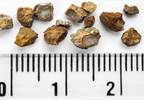 New guideline for managing kidney stones is released New guideline for managing kidney stones is released