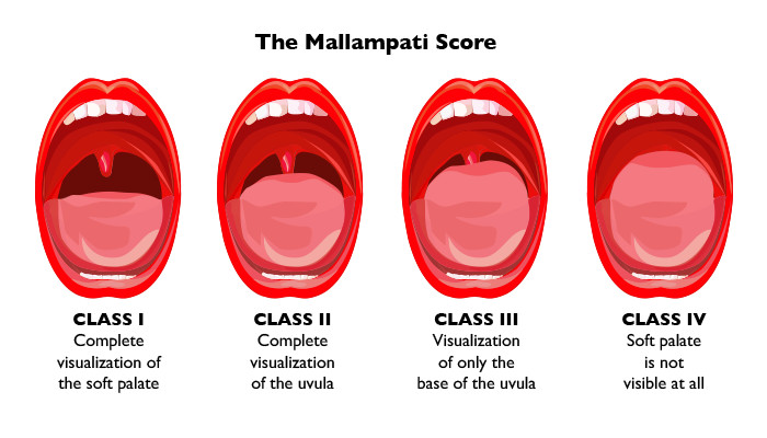 Resultado de imagen de mallampati