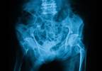 Weighing the benefits and harms of transvaginal mesh Weighing the benefits and harms of transvaginal mesh