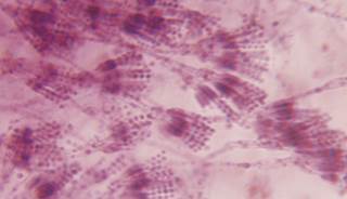 Prevalence of self-reported penicillin allergy was 3 times greater among those with chronic hives. Prevalence of self-reported penicillin allergy was 3 times greater among those with chronic hives.