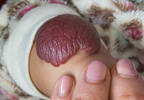Infantile hemangiomas: benign lesions with potential complications Infantile hemangiomas: benign lesions with potential complications