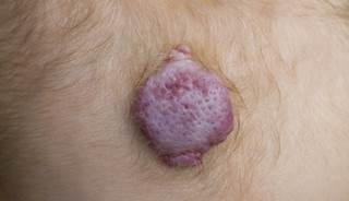 Approximately a quarter of patients with infantile hemangioma experience rebound growth. Approximately a quarter of patients with infantile hemangioma experience rebound growth.