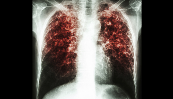 Latent tuberculosis infection screening recommended in at 