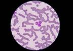 Definitions for sepsis, septic shock issued Definitions for sepsis, septic shock issued