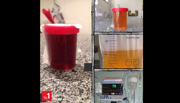 unusual-urine-color-during-catheterization-aafp