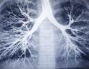COPD Frequently Misdiagnosed, Undiagnosed in Individuals With or Without HIV COPD Frequently Misdiagnosed, Undiagnosed in Individuals With or Without HIV