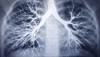 COPD Frequently Misdiagnosed, Undiagnosed in Individuals With or Without HIV COPD Frequently Misdiagnosed, Undiagnosed in Individuals With or Without HIV