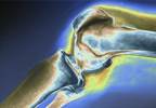 Osteoarthritis: conservative treatment options Osteoarthritis: conservative treatment options