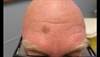 Derm Dx: A farm worker with a growing lesion Derm Dx: A farm worker with a growing lesion