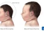 Zika virus confirmed as cause of microcephaly, congenital abnormalities Zika virus confirmed as cause of microcephaly, congenital abnormalities